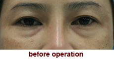 plastic-surgery-blepharoplasty